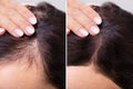 Before And After Hair Loss Treatment Royalty Free Stock Photo