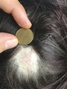 Hair loss on a womanÃ¢â¬â¢s head. You can see bald spots where hair does not grow. A man holds a coin to show the magnitude of the Royalty Free Stock Photo