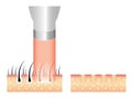 Hair removal laser icon step .laser emits an invisible light which penetrates the skin without damaging it.