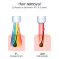 hair removal. Laser vs Intense Pulsed Light (IPL Royalty Free Stock Photo