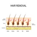 Hair removal