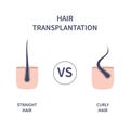 Hair transplantation for curly versus straight hair Royalty Free Stock Photo