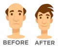 Hair transplantation before and after effect bald man