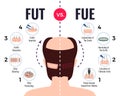 Hair Transplantation Fut Vs Fue Royalty Free Stock Photo