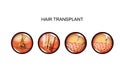 Hair transplantation. head