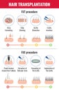 Hair Transplantation Infographics