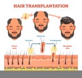 Hair Transplantation procedure diagram with steps