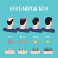 Hair transplantation surgery stages Royalty Free Stock Photo