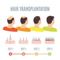 Hair transplantation in men Royalty Free Stock Photo