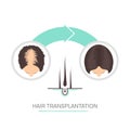 Hair transplantation for women-2 step infographics Royalty Free Stock Photo