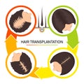 Hair transplantation for women 4 step infographics Royalty Free Stock Photo