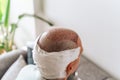 After hair transplantation surgical technique that moves hair follicles. Young bald man in bandage with hair loss Royalty Free Stock Photo