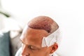 After hair transplantation surgical technique that moves hair follicles. Young bald man in bandage with hair loss Royalty Free Stock Photo