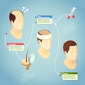 Hair Transplantation Vector Illustration