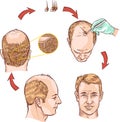 Hair transplantation