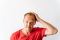 Before hair transplantation. Young bald man with hair loss problems holding his head Royalty Free Stock Photo