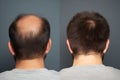 Hair treatment result before and after. Generative Ai Royalty Free Stock Photo