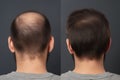 Hair treatment result before and after. Generative Ai Royalty Free Stock Photo