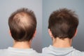 Hair treatment result before and after. Generative Ai