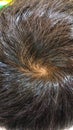 Hair whorl which is believed to determine personality
