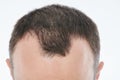 Hairloss in young age theme