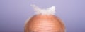 Hairtreatment and hairloss concept. Senior bald head closeup. Middle aged baldness man. Royalty Free Stock Photo