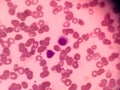 Hairy cell leukemia. Blood test, red blood cells