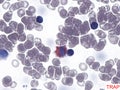 Hairy cell leukemia. TRAP-positive.