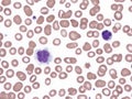 Hairy cell leukemia.