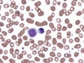 Hairy cell leukemia.