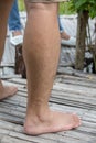 Hairy legs with stains and birthmarks on the skin