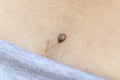 Hairy skin mole or melanoma of the skin of the back on a man`s body. Proliferation of pigment dermal cells. Dermatologist medical