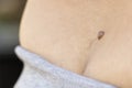 Hairy skin mole or melanoma of the skin of the back on a man`s body. Proliferation of pigment dermal cells. Dermatologist medical