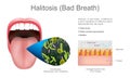 Halitosis bad breath. Education info graphic. Vector design. Royalty Free Stock Photo