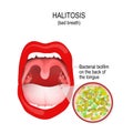 Halitosis. Bad breath