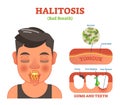 Halitosis. Bad breath vector illustration diagram poster.