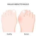 Hallux abducto valgus. healthy joint and bunion