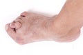 Hallux abductus valgus Royalty Free Stock Photo