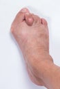 Hallux abductus valgus