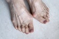 Hallux valgus, big abnormal feet bones. Bunion on big toes of female feet