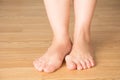 Hallux valgus, bunion in foot, pain in legs Royalty Free Stock Photo