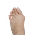 Hallux valgus, bunion in foot