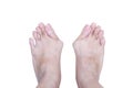 Hallux valgus, bunion in foot on white background Royalty Free Stock Photo