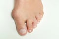 Hallux valgus, bunion in woman foot on white background Royalty Free Stock Photo