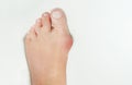 Hallux valgus, bunion in woman foot on white background Royalty Free Stock Photo