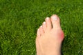 Hallux valgus, bunion in woman foot on grass background