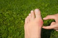 Hallux valgus, bunion in woman foot on grass background Royalty Free Stock Photo