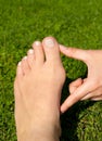 Hallux valgus, bunion in woman foot on grass background Royalty Free Stock Photo