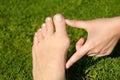 Hallux valgus, bunion in woman foot on grass background