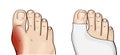 Hallux valgus is the commonest forefoot deformity